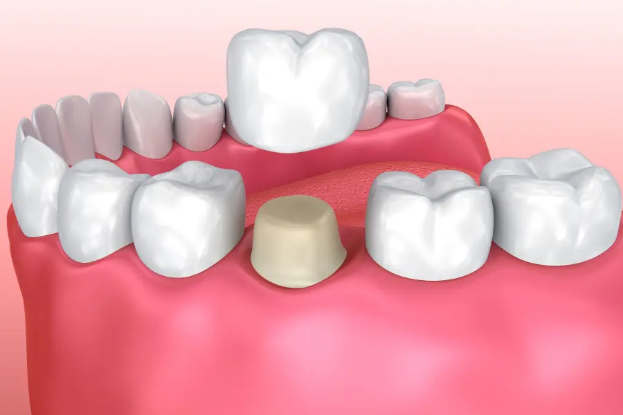 Luminous teeth whitening results