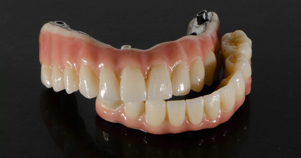 All-on-4 Dentures