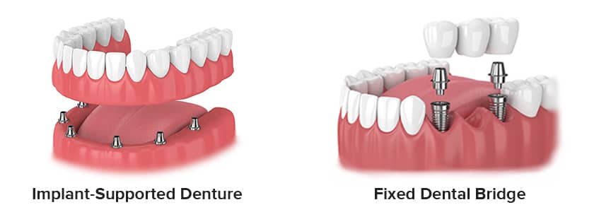 Fixed Bridge vs. Implant-Supported Dentures