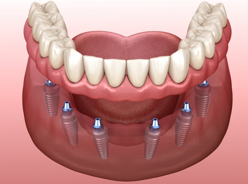 Permanent Dentures