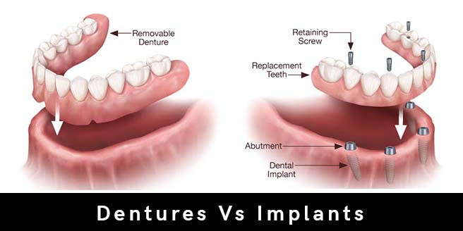 Traditional Dentures vs. Implant-Supported Dentures