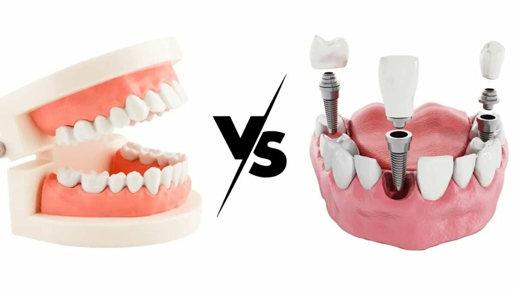 Differences between Permanent Dentures and Dental Implants