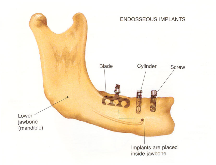 Endosseous implants