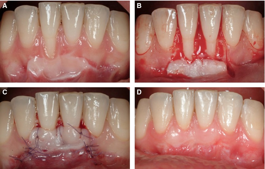 Evolution of a gum graft