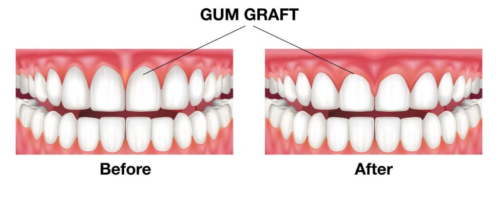 What are the results of a gum graft