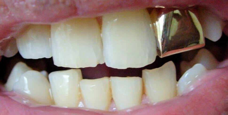 dental crown last