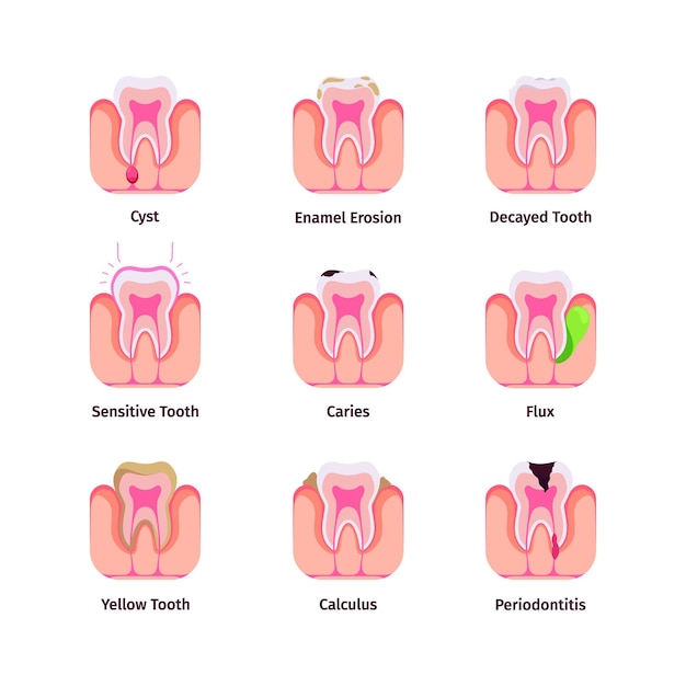 types of cavities