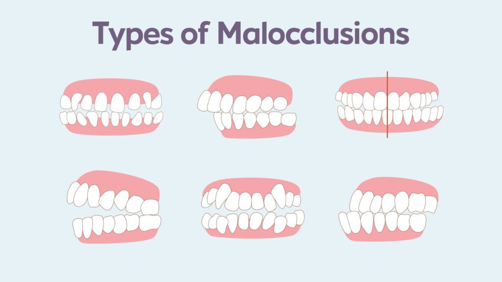 Types of dental malocclusion