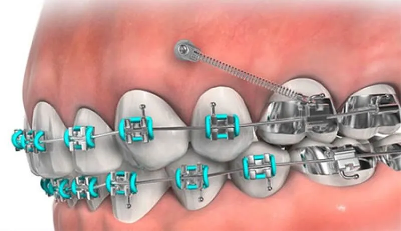 implants and orthodontics